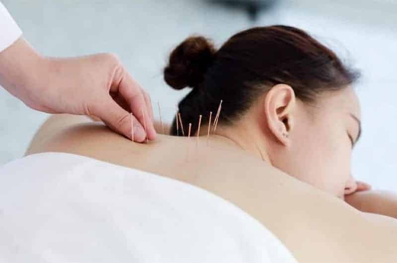 Dry Needling